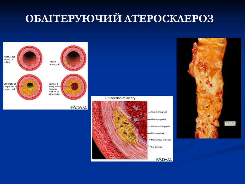 ОБЛІТЕРУЮЧИЙ АТЕРОСКЛЕРОЗ ОБЛІТЕРУЮЧИЙ АТЕРОСКЛЕРОЗ